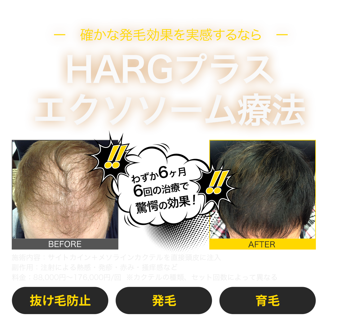 確かな発毛効果を実感するならHARGプラス エクソソーム療法