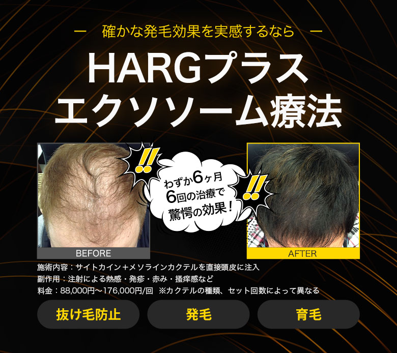 確かな発毛効果を実感するならHARGプラス エクソソーム療法